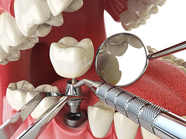 Best Chipped Tooth Repair Near Me  in Estero, FL